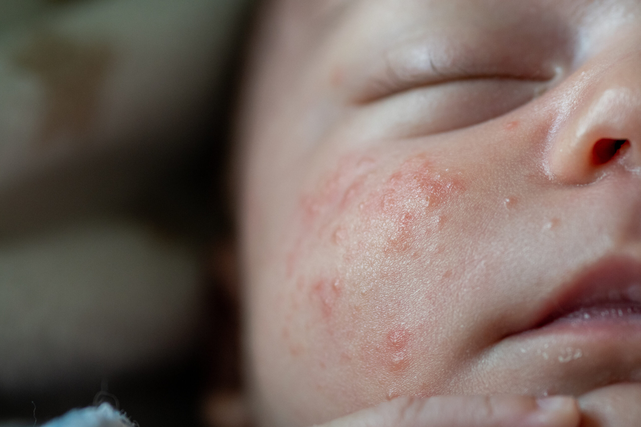 What Are Those Rashes on Your Newborn’s Skin?